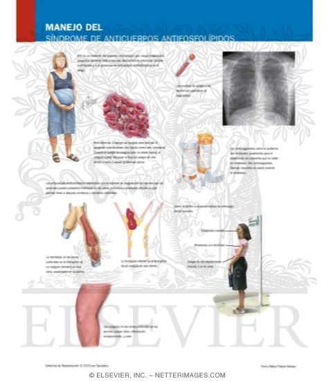 Watermarked preview of labeled image: Managing Your Antiphospholipid Antibody Syndrome