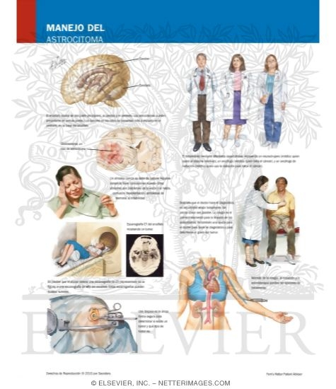 Watermarked preview of labeled image: Managing Your Astrocytoma