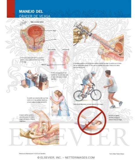 Managing Your Bladder Cancer