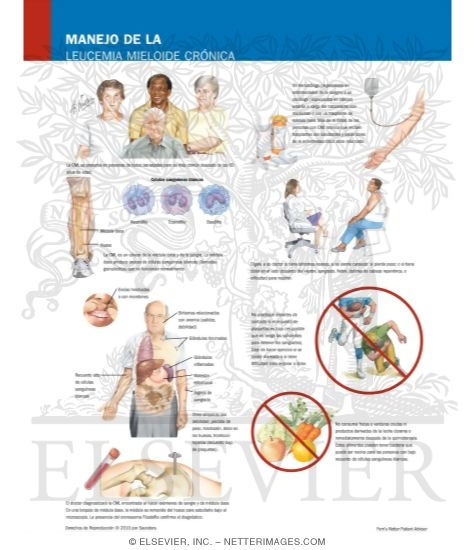 Manejo de la Leucemia Mieloide Crónica