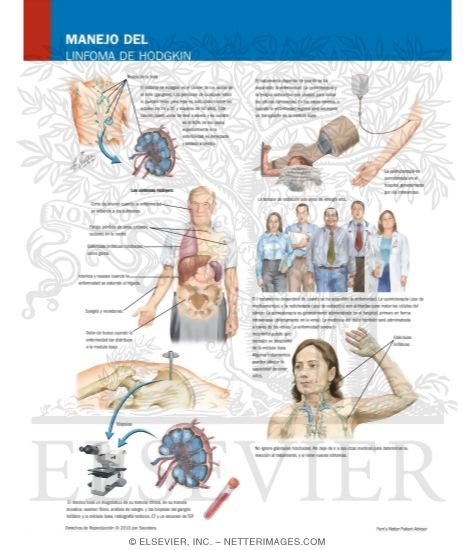 Watermarked preview of labeled image: Managing Your Hodgkin's Lymphoma