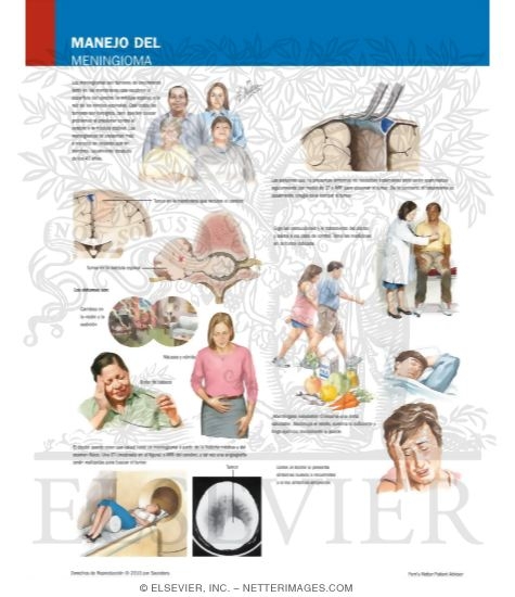 Watermarked preview of labeled image: Managing Your Meningioma
