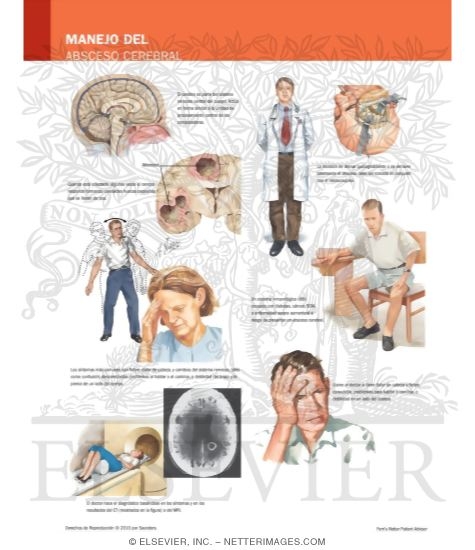 Watermarked preview of labeled image: Managing Your Brain Abscess