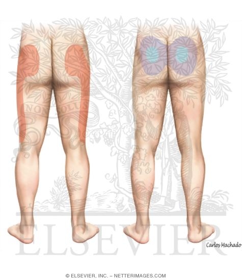 Sacroiliac Joint Pain Referral Patterns