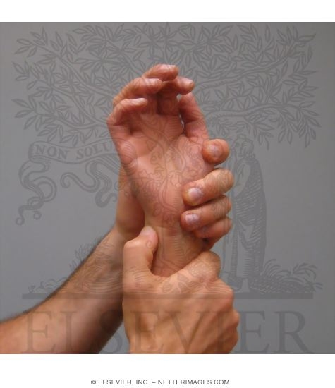 Ulnar Fovea Sign