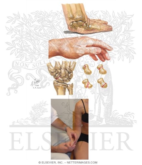 Testing for Tenderness of Anatomical Snuff Box