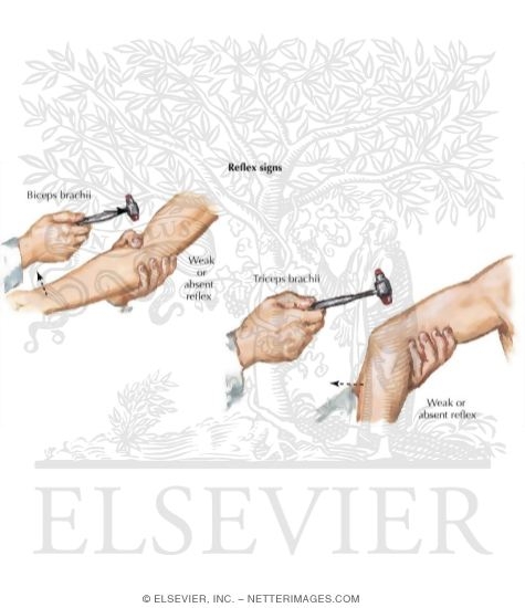 Cervical Radiculopathy: Muscle Stretch Reflexes