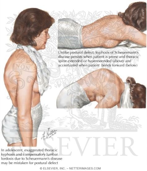 Watermarked preview of labeled image: Scheuermann's Disease