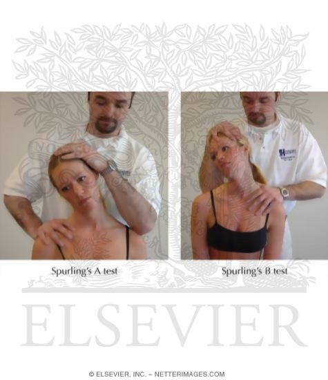 Watermarked preview of labeled image: Spurling's Test