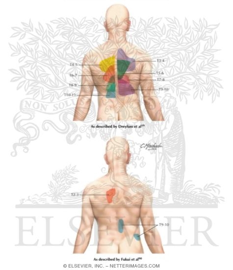 Zygapophyseal Pain Patterns of the Thoracic Spine