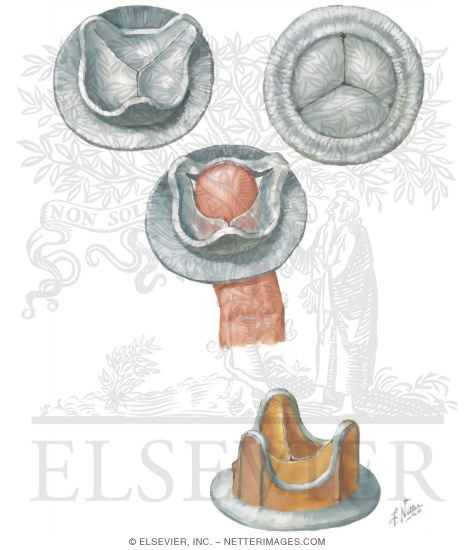 Watermarked preview of unlabeled image: Bioprosthetic Heart Valves