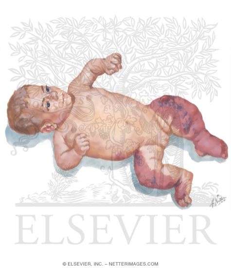 Watermarked preview of unlabeled image: Hemangioma