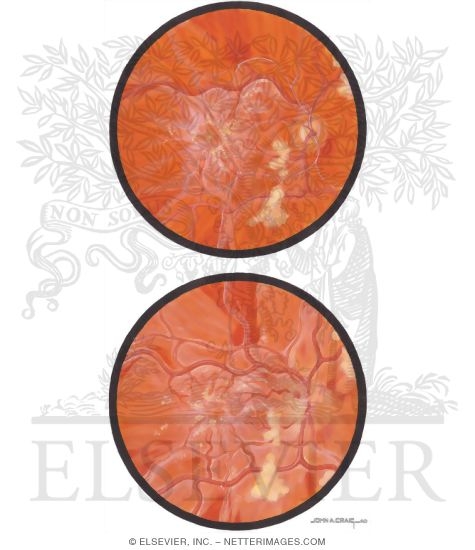 Hypertensive Retinopathy