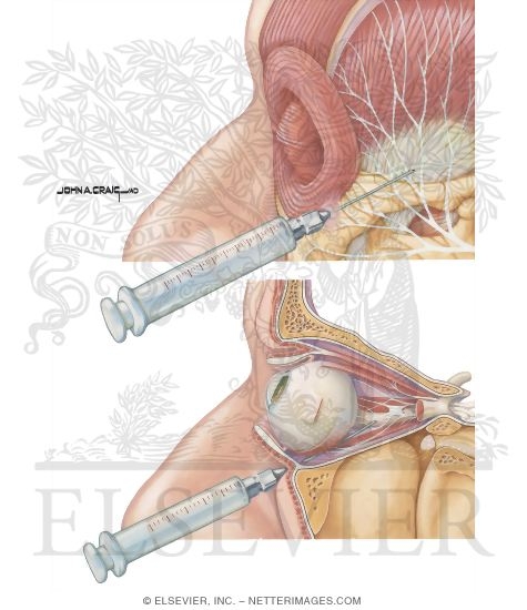 Methods of Anethesia and Akinesia for Cataract Surgery