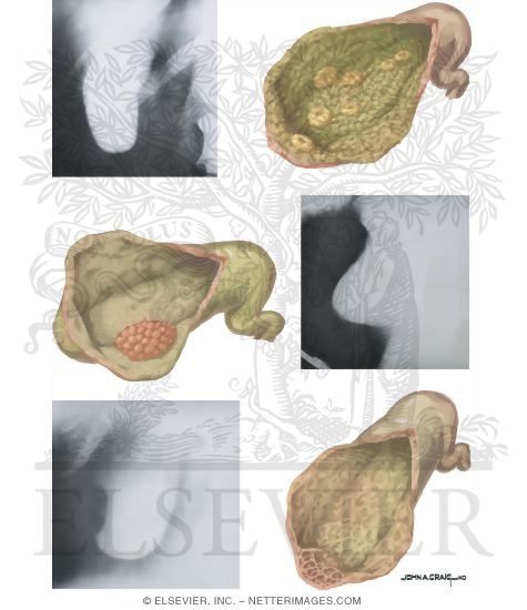 Watermarked preview of unlabeled image: Gallstones Benign Lesions of Gallbladder