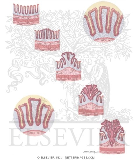 Watermarked preview of unlabeled image: Colorectal Cancer Polyp-cancer Sequence