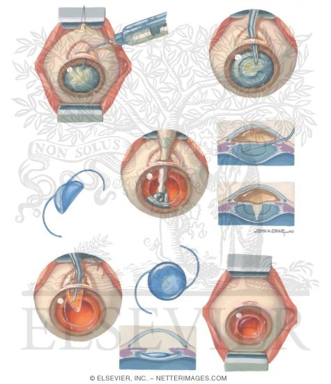 phacoemulsification