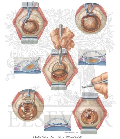 Cataracts Intracapsular Cataract Extraction and Insertion of IOL