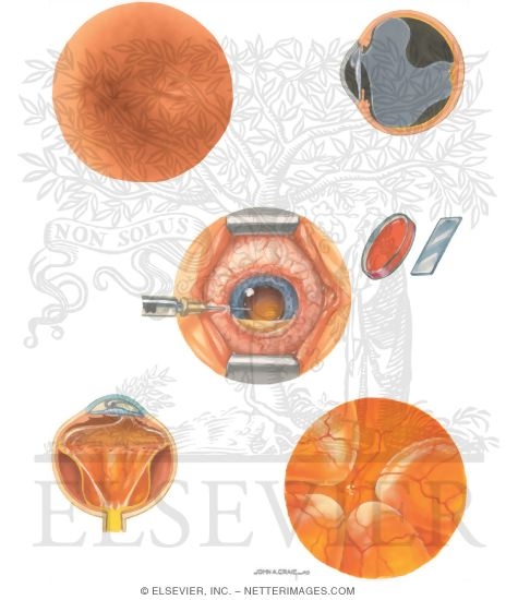 Watermarked preview of unlabeled image: Cataracts Complications of Cataract Surgery