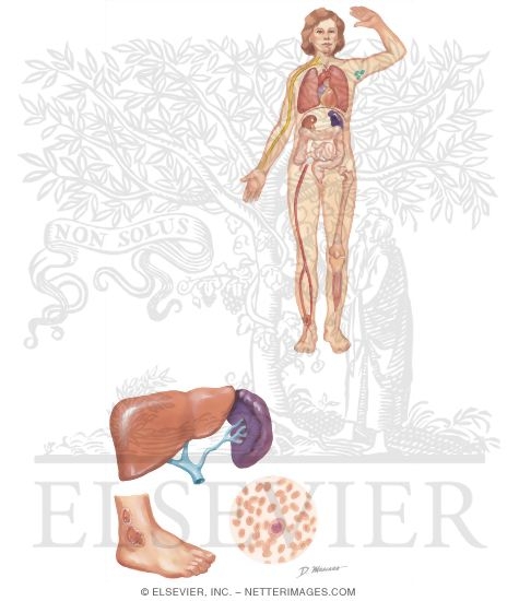 Systemic Manifestations of Rheumatoid Arthritis