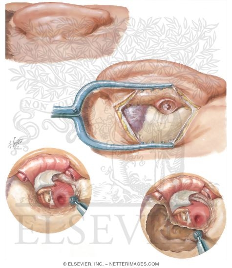 Postauricular Tympanoplasty-Mastoidectomy
