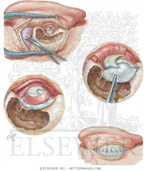 Postauricular Tympanoplasty-Mastoidectomy