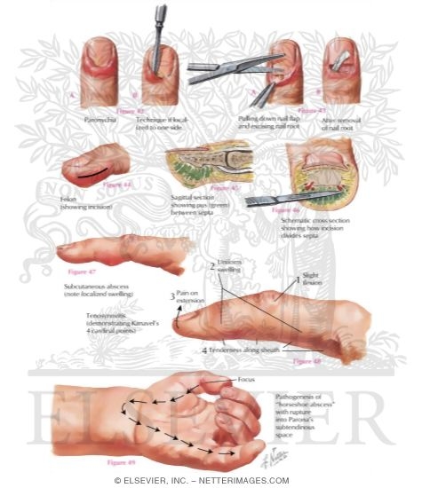 Surgical Incisions