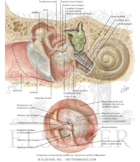 Otosclerosis