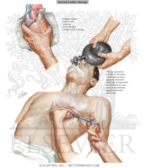 Cardiopulmonary Arrest And Treatment Internal Cardiac Massage An emergency medical procedure for treating heart failure. treatment internal cardiac massage