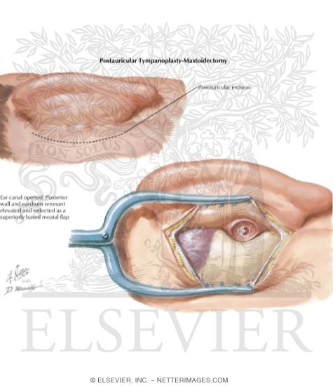 Postauricular Tympanoplasty and Mastoidectomy