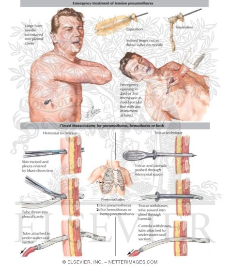 Treatment of Tension Pneumothorax Insertion of Drainage Tubes