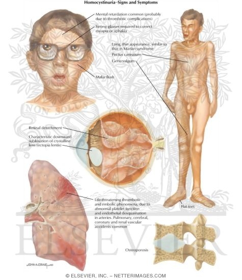 Birth Defects: Homocystinuria - Signs and Symptoms