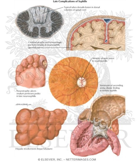 Late Complications of Syphilis