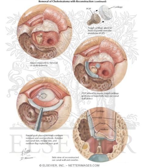 Watermarked preview of labeled image: Removal of Cholesteatoma With Reconstruction