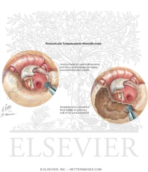 Postauricular Tympanoplasty and Mastoidectomy