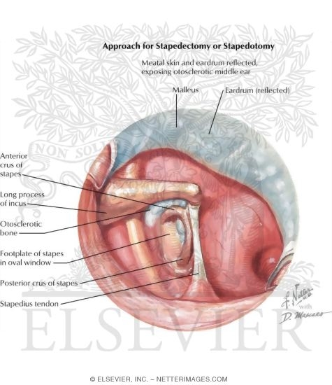 Watermarked preview of labeled image: Approach for Stapedectomy Or Stapedotomy