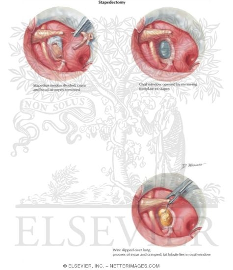 Watermarked preview of labeled image: Stapedectomy