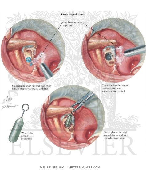 Watermarked preview of labeled image: Laser Stapedotomy