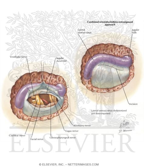 Vestibular Nerve Section