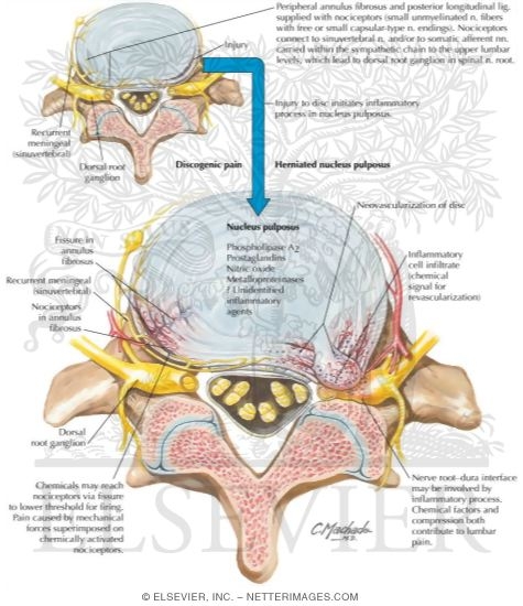 Watermarked preview of labeled image: Role of Inflammation In Lumbar Pain