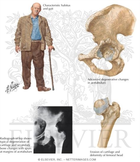 Hip Joint Involvement in Osteoarthritis