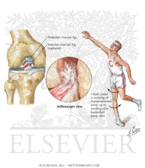 Watermarked preview of labeled image: Rupture of the Anterior Cruciate Ligament