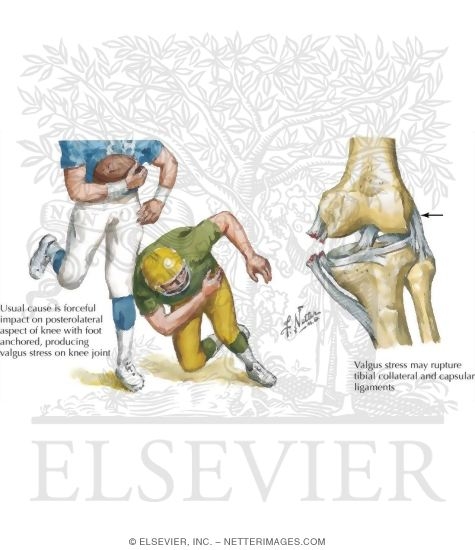 Sprains of Knee Ligaments