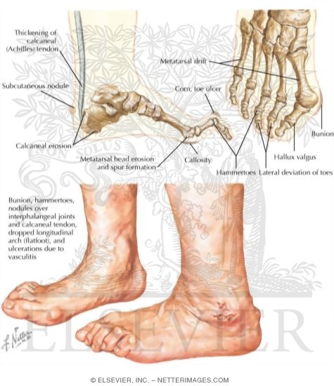 The Feet In Rheumatoid Arthritis