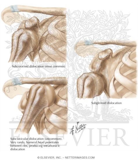 Shoulder Instability