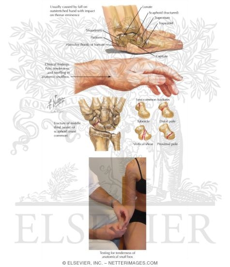 Testing for Tenderness of Anatomical Snuff Box