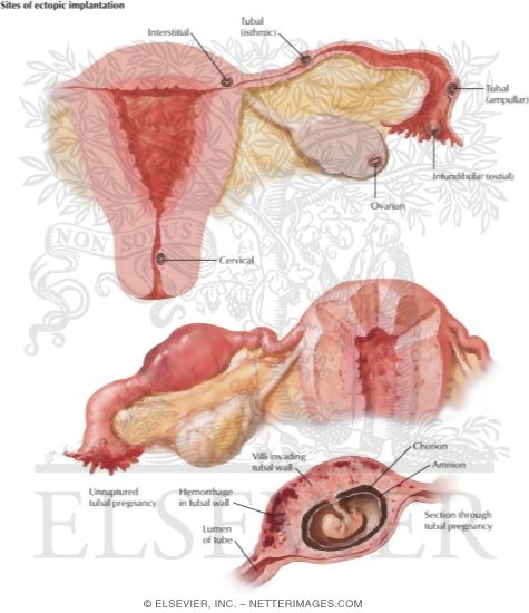 Watermarked preview of labeled image: Ectopic Pregnancy