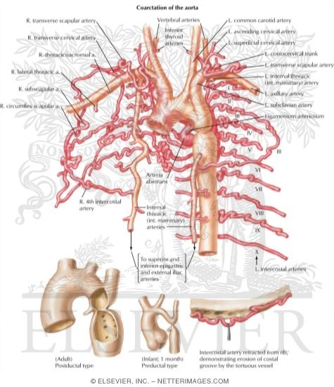 Anomalies of the Aortic-Arch System
Anatomic Features of Aortic Coarctation In Older Children and Neonates
