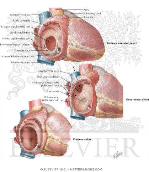 Atrial Septal Defects