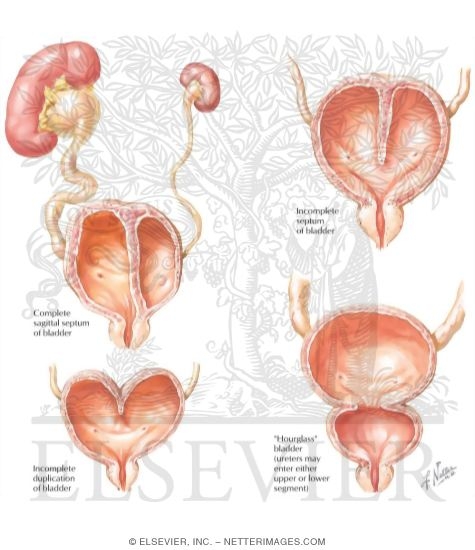 Watermarked preview of labeled image: Bladder Anomalies